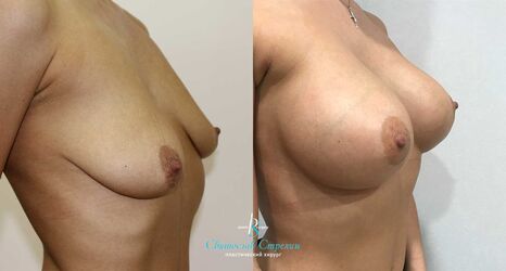 Увеличение груди, 1 месяца после операции, импланты Себбин 425 мл, анатомические, большая высота, высокая проекция, доступ подмышечный