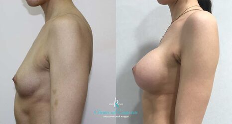 Увеличение груди, 4 месяца после операции, импланты Себбин 425 мл, анатомические, большая высота, высокая проекция, доступ подмышечный
