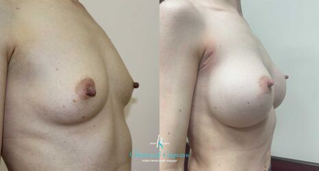Увеличение груди, 3 года после операции, импланты Себбин 380 мл, анатомические, большая высота, высокая проекция, доступ подмышечный