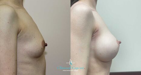 Увеличение груди, 3 года после операции, импланты Себбин 380 мл, анатомические, большая высота, высокая проекция, доступ подмышечный
