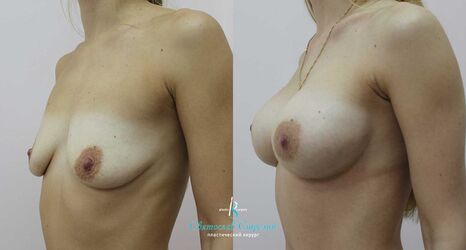 Увеличение груди, 6 месяцев после операции, импланты Себбин 415 мл, анатомические, средняяв ысота, высокая проекция, доступ подмышечный