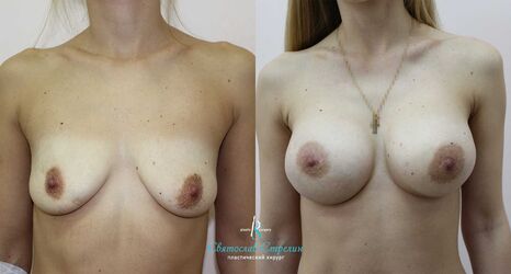 Увеличение груди, 6 месяцев после операции, импланты Себбин 415 мл, анатомические, средняяв ысота, высокая проекция, доступ подмышечный