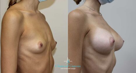 Увеличение груди, 9 месяцев после операции, импланты Себбин 325 мл, анатомические, средняяв ысота, высокая проекция, доступ подмышечный
