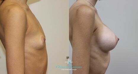 Увеличение груди, 9 месяцев после операции, импланты Себбин 325 мл, анатомические, средняяв ысота, высокая проекция, доступ подмышечный