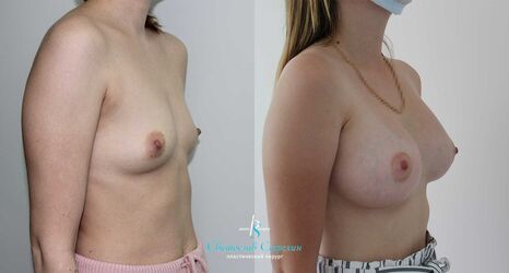 Увеличение груди, 4 месяца после операции, импланты Себбин 415 мл, анатомические, средняяв ысота, высокая проекция, доступ подмышечный