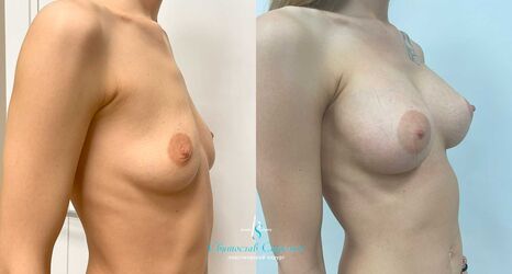Увеличение груди, 8 месяцев после операции, импланты Себбин 380 мл, анатомические, большая высота, высокая проекция, доступ подмышечный