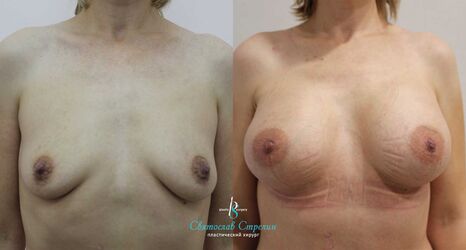 Увеличение груди, 1 месяц после операции, импланты Себбин 375 мл, анатомические, большая высота, средняя проекция, доступ подмышечный