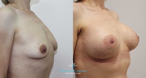 Увеличение груди, 1 месяц после операции, импланты Себбин 375 мл, анатомические, большая высота, средняя проекция, доступ подмышечный