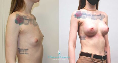 Увеличение груди, 2 месяца после операции, импланты Себбин 290 мл, анатомические, большая высота, высокая проекция, доступ подмышечный