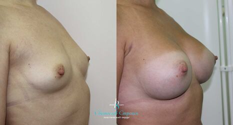 Увеличение груди, 6 месяцев после операции, импланты Себбин TF425 справа и TM375 слева