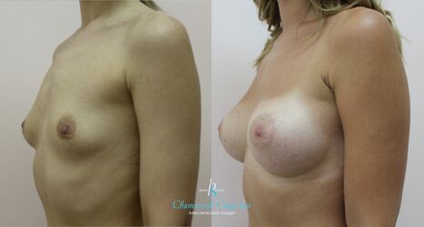 Увеличение груди, 9 месяцев после операции, импланты Себбин 380 мл, анатомические, большая высота, высокая проекция, доступ подмышечный