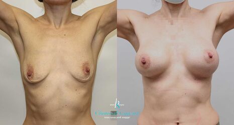 Увеличение груди, 3 месяца после операции, импланты Себбин 380 мл, анатомические, большая высота, высокая проекция, доступ подмышечный