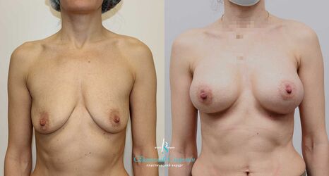 Увеличение груди, 3 месяца после операции, импланты Себбин 380 мл, анатомические, большая высота, высокая проекция, доступ подмышечный