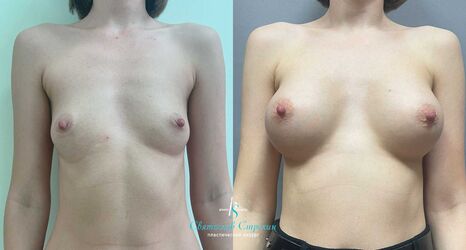Увеличение груди, 6 месяцев после операции, импланты Силимед 320 мл, анатомические, средняяв ысота, высокая проекция, доступ подмышечный