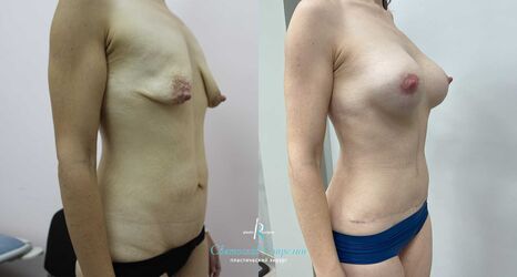 Абдоминопластика и увеличение груди с подтяжкой, 1 год после операции
