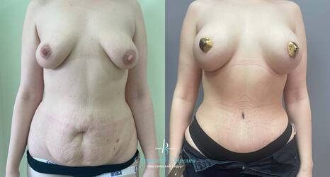 Абдоминопластика с липосакцией боков, спины, увеличение с подтяжкой груди, 10 месяцев после операции