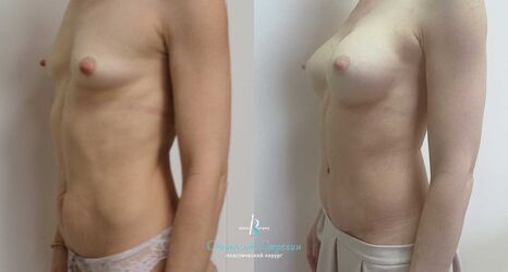 Абдоминопластика, увеличение груди через подмышечный доступ, 6 месяцев после операции