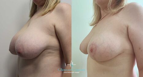Уменьшение груди, 6 месяцев после операции