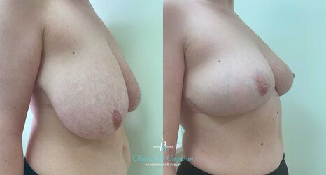 Уменьшение груди, 6 месяцев после операции